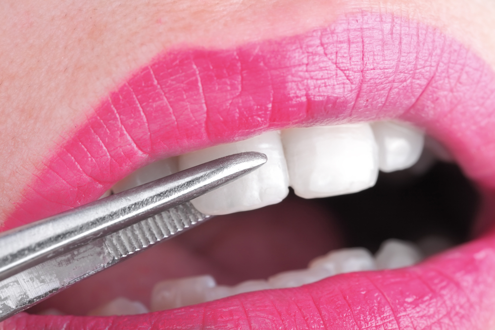 Lumineers vs dental veneers Lumineers vs dental veneers